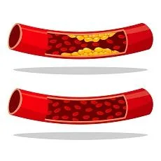 Imagen informativa sobre Niveles de colesterol: Lo que usted debe saber