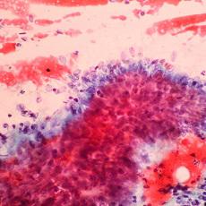 Imagen informativa sobre Cáncer de cuello uterino