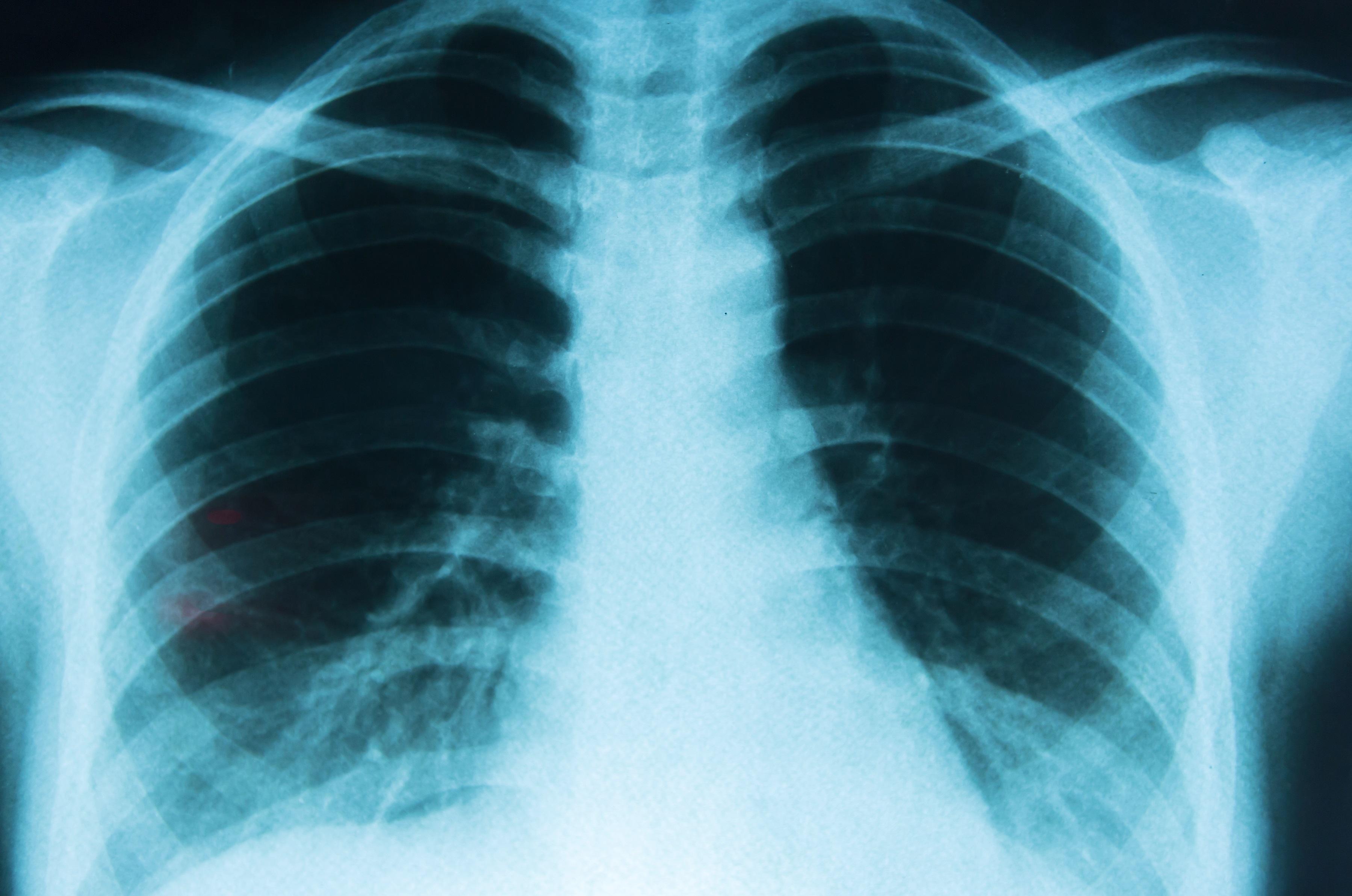 Imagen informativa sobre Cáncer de pulmón