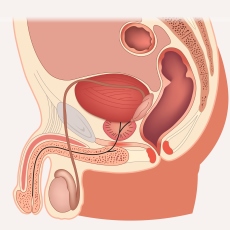 Imagen informativa sobre Cáncer de testículo
